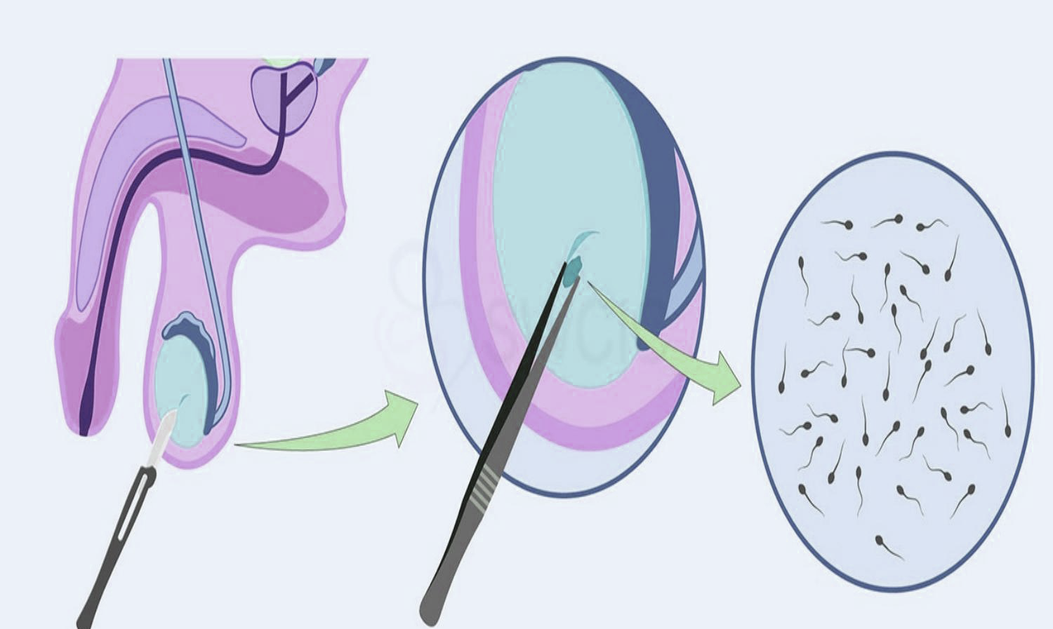 Surgery- maa fartility