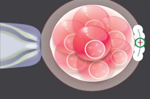 Laser-Assisted Hatching - maa fartility